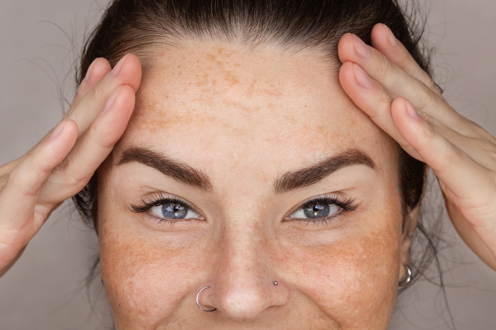 Caucasian,Woman’s,Face,With,Freckles,Or,Age,Spots,,Melasma,,