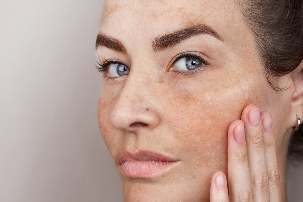 Close,Up,Caucasian,Woman’s,Face,With,Freckles,Or,Age,Spots,