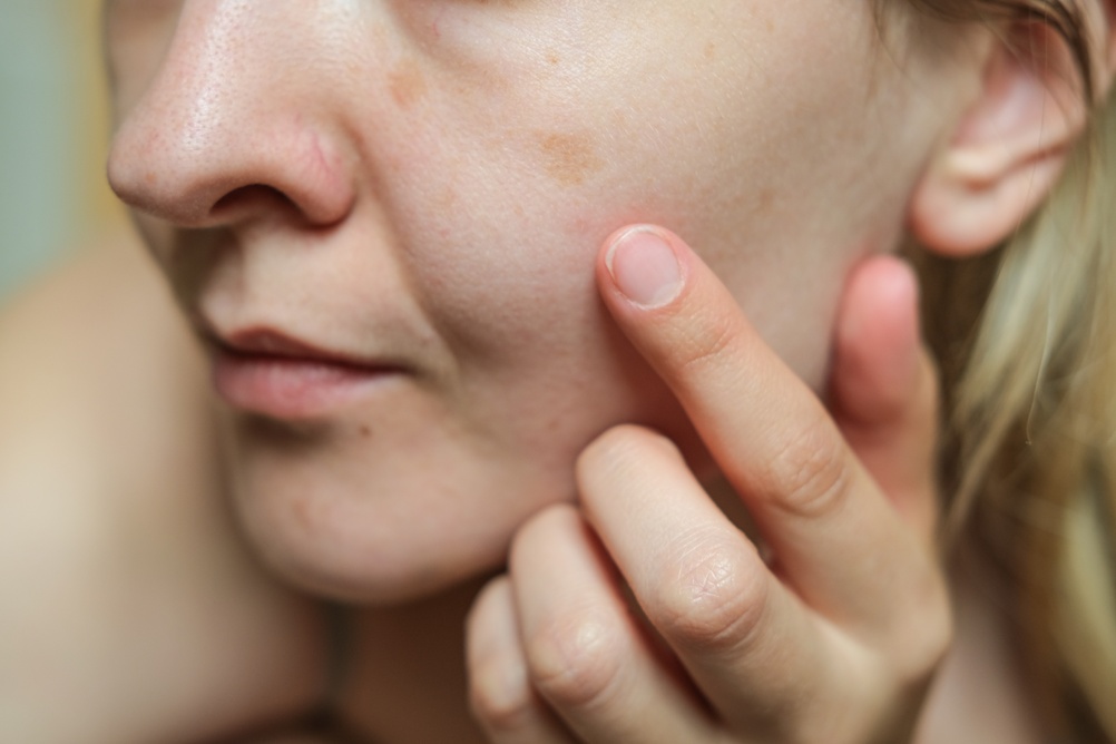 Close-up,Of,Woman,Face,Showing,Pigmentation,Spots,And,Uneven,Skin
